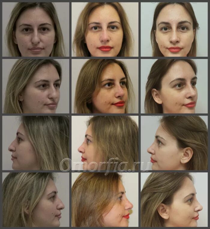 Ринопластика по месяцам. Изменение носа по месяцам. ринопластика спустя полгода. ринопластика через 6 месяцев.