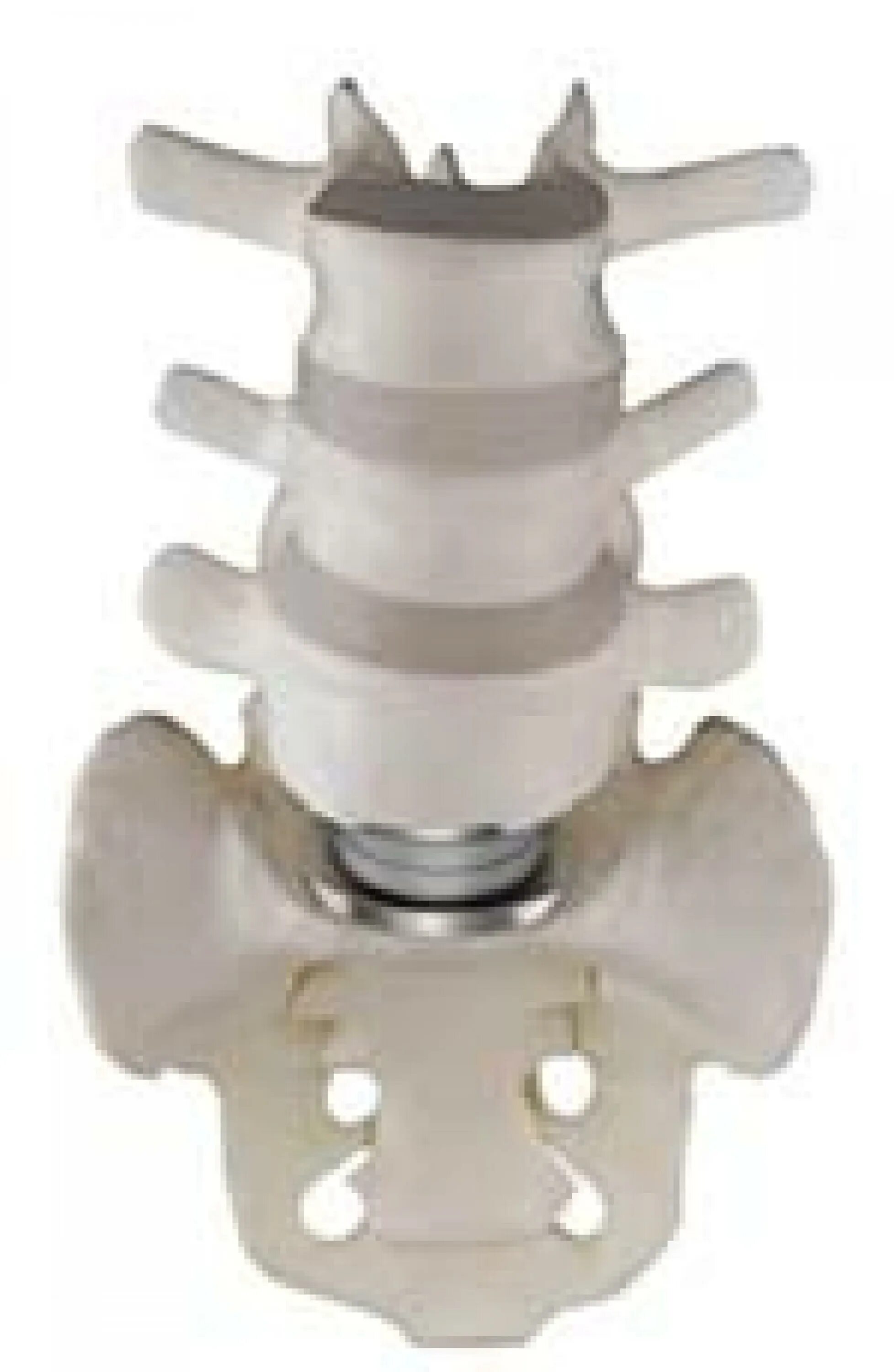 Имплант шейного отдела позвоночника. Имплант межпозвонкового диска l5-s1. Имплант позвоночного диска l5 s1. Имплант Кейдж позвоночник. Кейдж для позвоночника поясничного отдела.