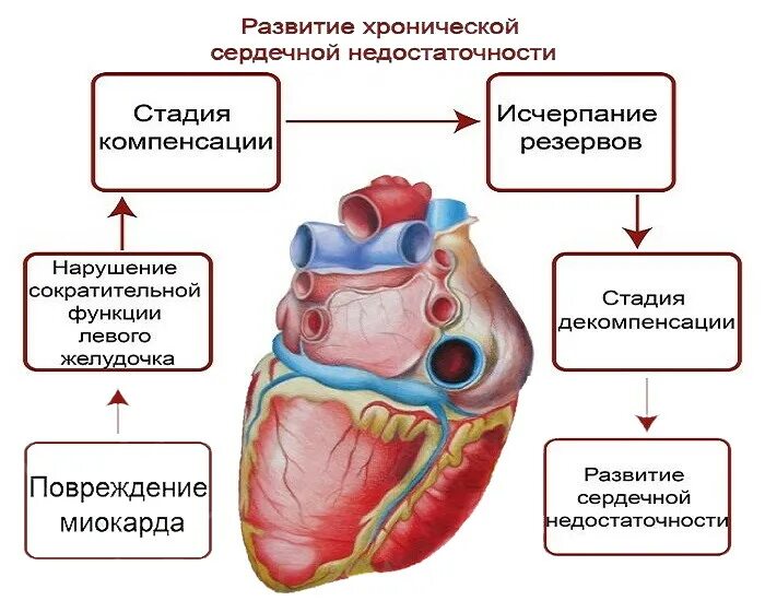 Хроническая сердечная недостаточность компенсации декомпенсации. Осложнения хронической коронарной недостаточности. ХСН В стадии декомпенсации. Острой сердечной недостаточности стадии декомпенсации. Понятие сердечной недостаточности