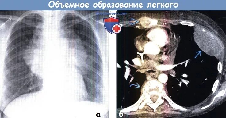 Образования в легких человека