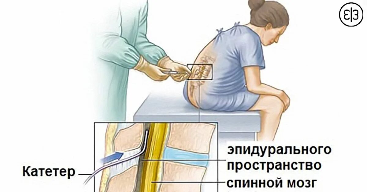 Субдуральная и эпидуральная анестезия. Спинномозговая и эпидуральная анестезия. Эпидуральная анестезия игла размер. Люмбальная эпидуральная анестезия.