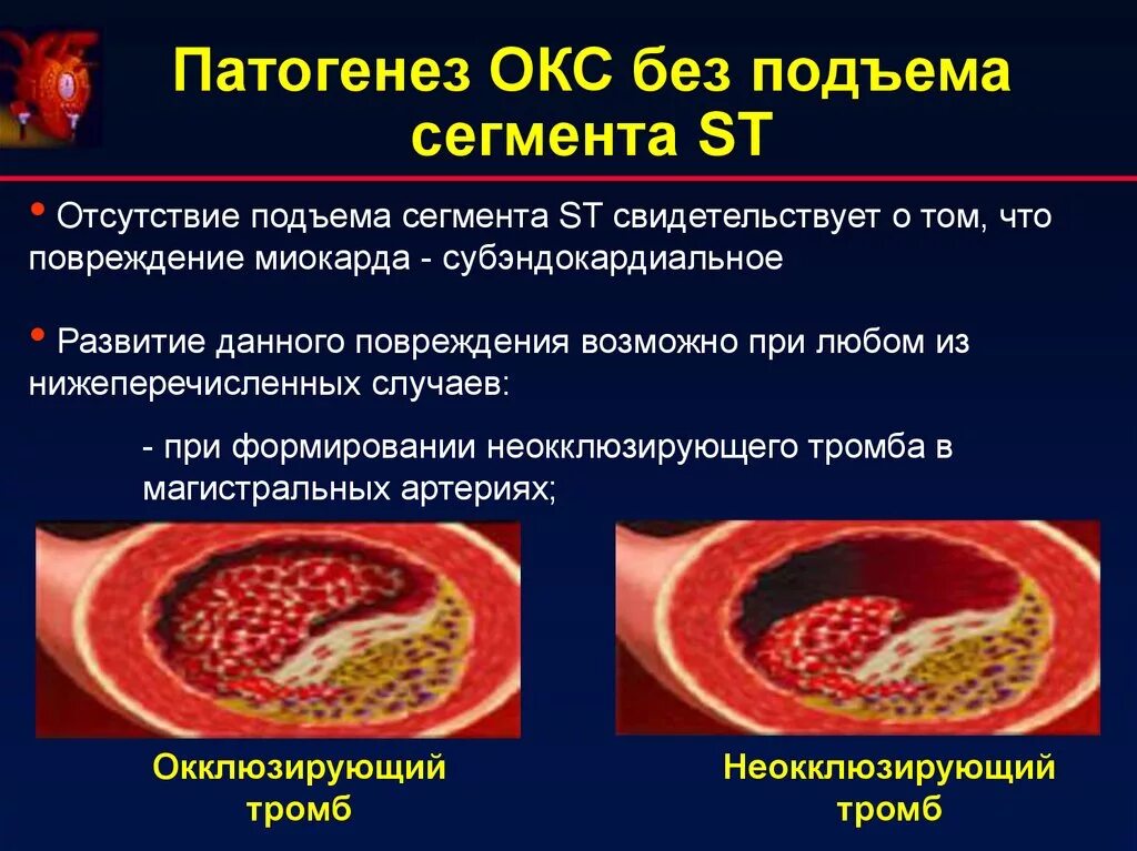 Острый коронарный синдром инфаркт. Острый коронарный синдром патогенез. Патогенез Окс без подъема St. Острый коронарный синдром без подъема сегмента. Механизмы развития острого коронарного синдрома.