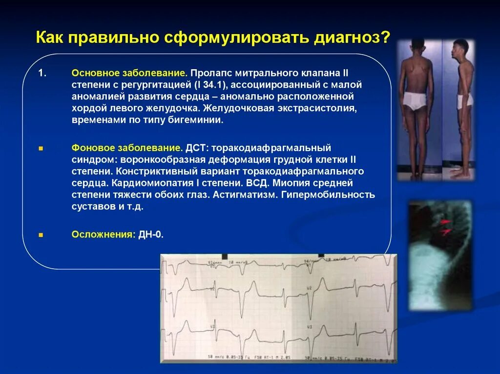 Диагноз пролапс. Пролапс митрального клапана формулировка диагноза. митральный пролапс формулировка диагноза. пролапс митрального клапана диагноз формулировка диагноза. пролапс митрального клапана пример формулировки диагноза.