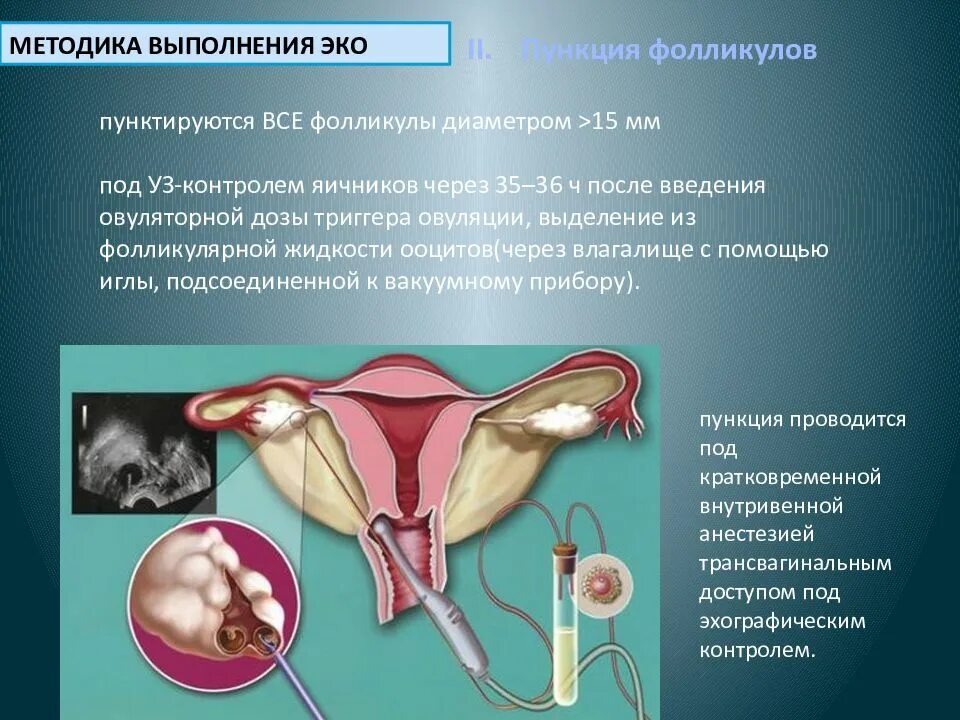 Пункция фолликулов яичников. Экстракорпоральное оплодотворение презентация. Боли после пункции фолликулов