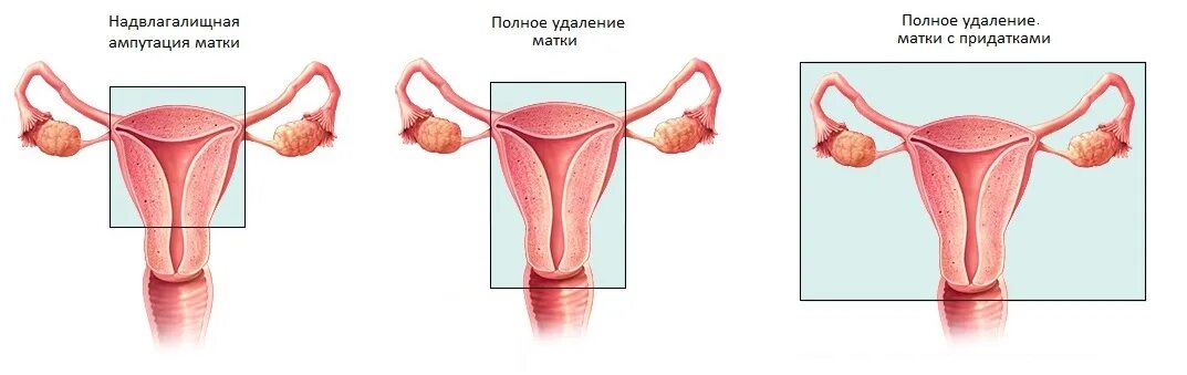 Гистерэктомия что это такое простыми. Экстирпация матки с придатками. Пангистерэктомия с придатками. Ампутация матки с придатками. Надвлагалищная ампутация матки с придатками.