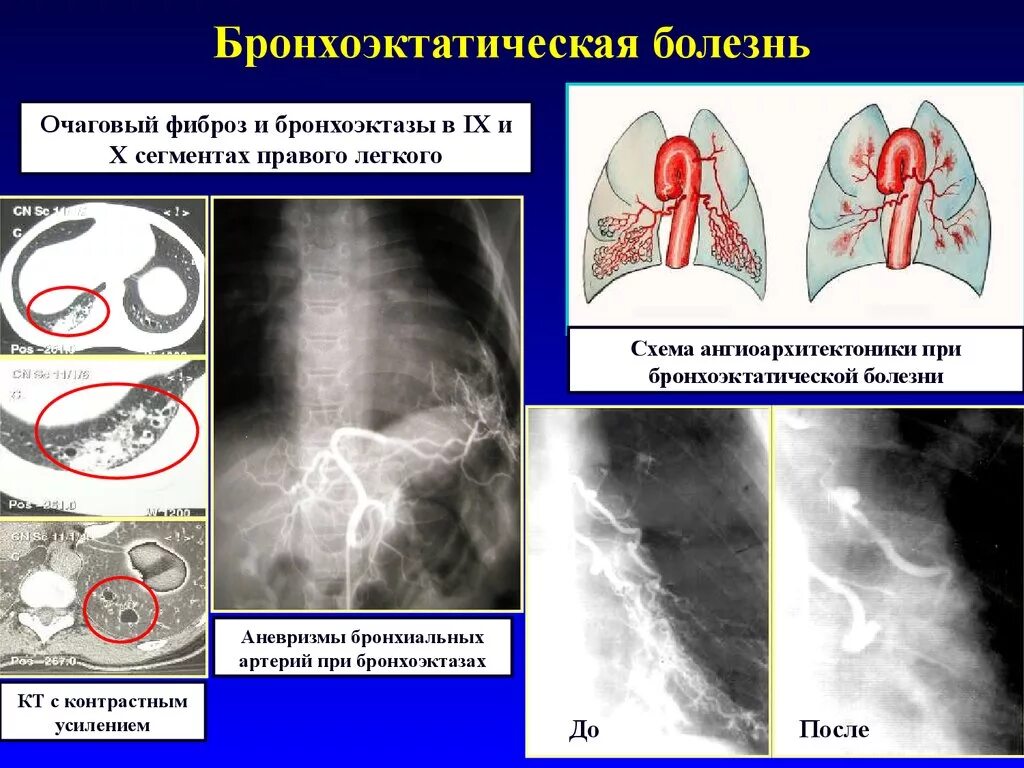 Бронхит бронхоэктатическая болезнь. Легочная ткань бронхоэктатическая болезнь. Бронхоэктатическая болезнь патология. Фиброз при бронхоэктатической болезни. Бронхоэктатической боле.