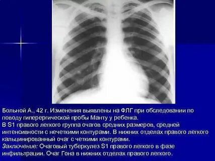 Очаг в верхней доле левого легкого