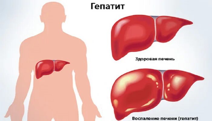 Гепатит б синдромы. Печен.гипти.с.