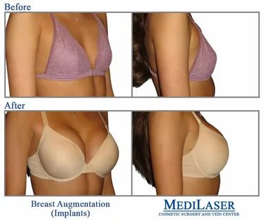 Breast Augmentation Before And After Teen.