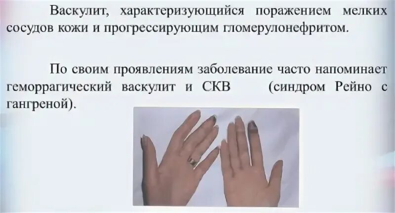 Васкулит какие анализы