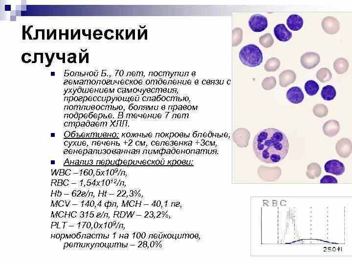 Анемия при хроническом лимфолейкозе. Анализ клинических случаев. Лимфолейкоз показатели крови. Хронический лимфолейкоз лабораторная диагностика. Хронический лимфолейкоз клинические