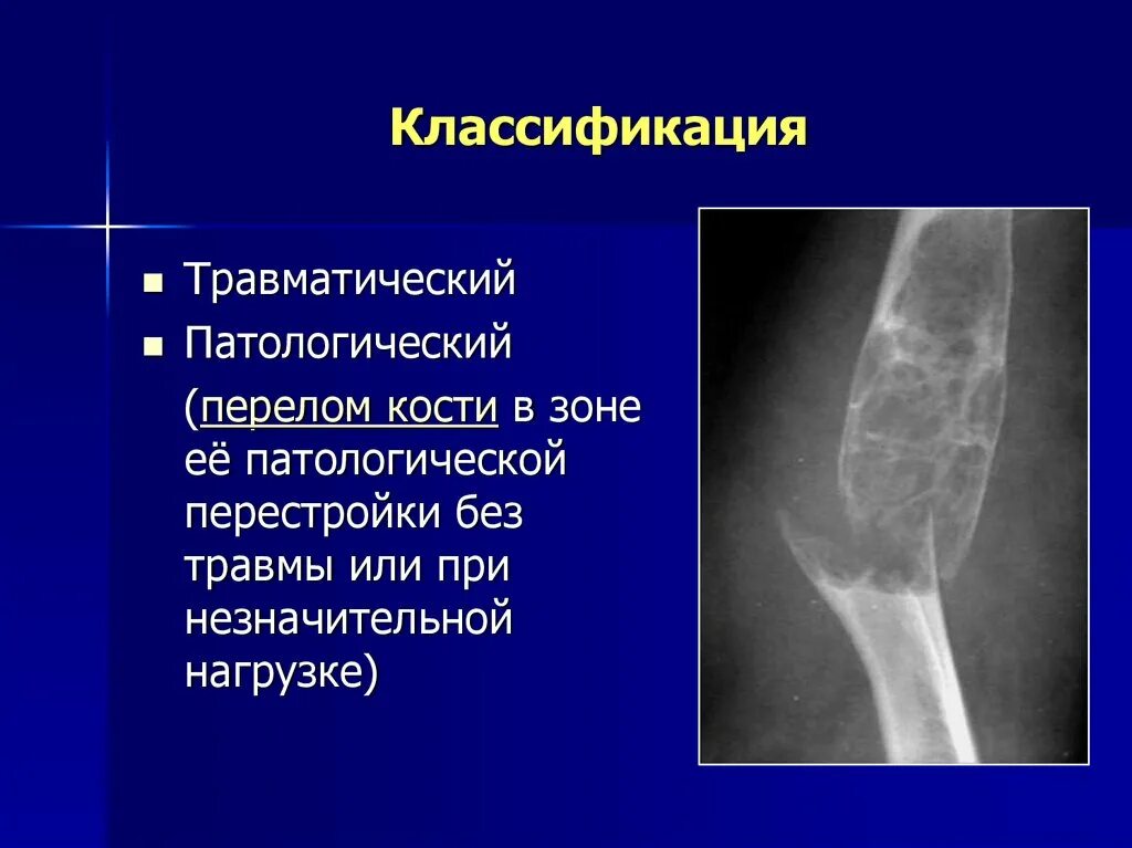 Разрыв кости. Патологический перелом. Рентгенодиагностика травматических повреждений костей и суставов. Травматические и патологические переломы. Рентгенодиагностика перелом кости.