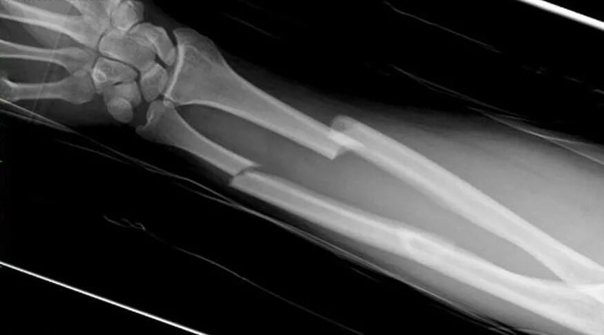 Рентгенограмма перелом кости. Перелом лучезапястного сустава рентген. Перелом костей лучезапястного сустава рентген.