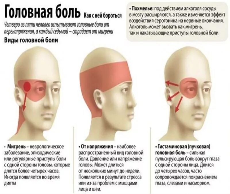 Что будет если пить головы. Локализация глазной боли. боль в висках головы. мигрень и головная боль напряжения. типы головной боли.
