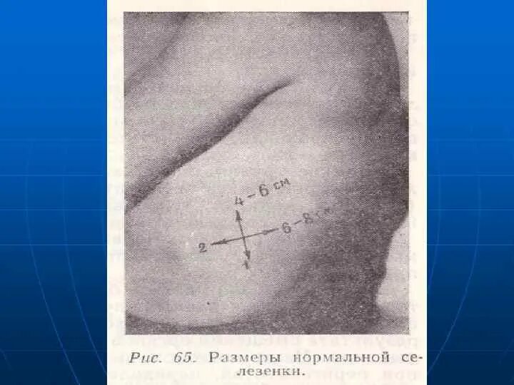 Перкуссия печени и селезенки пропедевтика. Перкуссия селезенки в норме границы. Методика пальпации селезенки. Пальпация и перкуссия печени и селезенки. Малые размеры селезенки