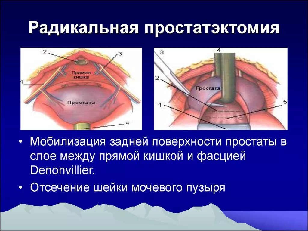 Радикальная позадилонная простатэктомия ход операции. Радикальная простатэктомия (позадилонная, лапароскопическая);. Радикальное простотоэктомия. Эктомия\ предстательной железы.