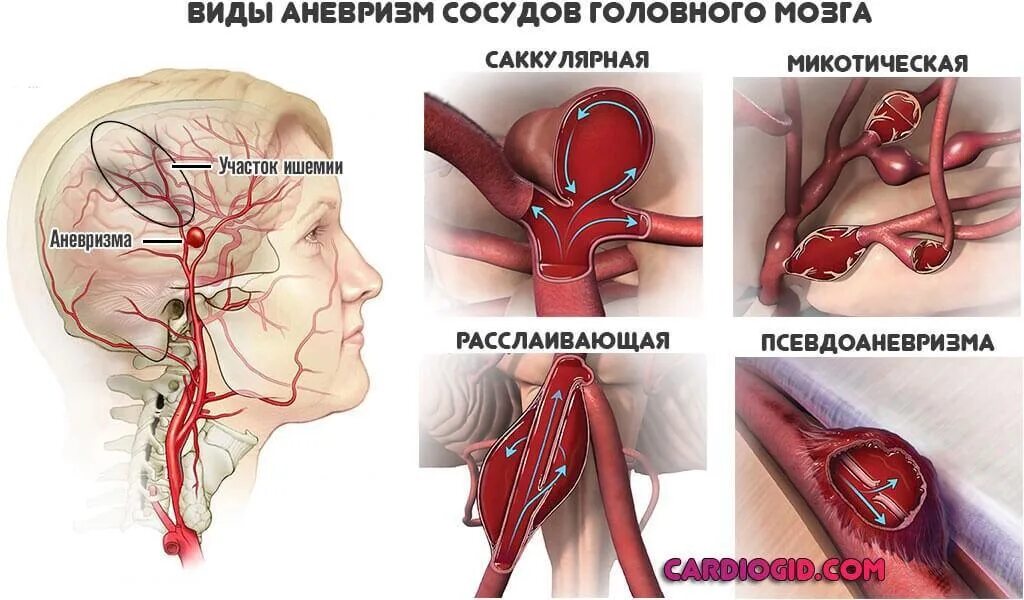 Форум аневризма мозга. Аневризма артерии головного мозга. Эндоваскулярная аневризма головного мозга. Классификация аневризм сосудов головного мозга. Артериальная аневризма сосудов головного мозга.