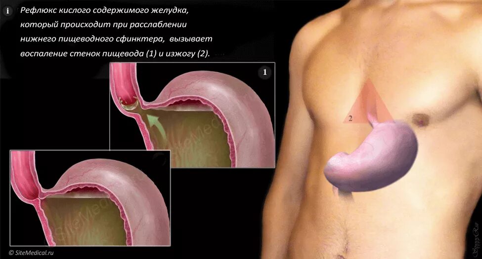 Лечение пищевода симптомы у взрослых. Болезнь желудка рефлюкс эзофагит. Гастрит рефлюкс эзофагит. Хронический неэрозивный рефлюкс эзофагит.