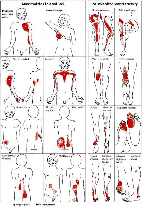 Methods of Examination of Patients with Trigher Zones. 1. Active survey The pati