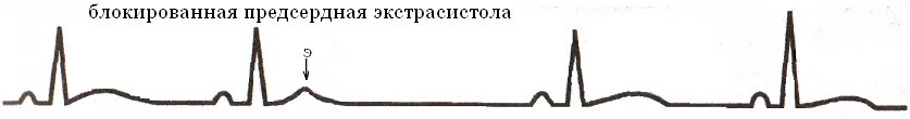 Блокированные предсердные экстрасистолы на ЭКГ. Блокированная экстрасистолия на ЭКГ. Предсердная экстрасистолия на ЭКГ. Блокированная экстрасистола предсердная экстрасистолия. Блокированные экстрасистолы