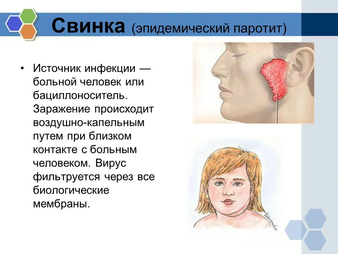 Какие признаки свинки. Симптом Филатова эпид паротит. Эпидемический паротит симптомы. Эпидемический паротит Свинка источник заражения. Эпидемический паротит продромальный период.