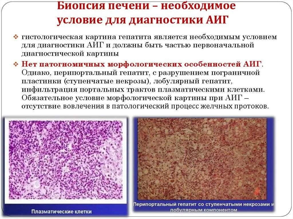 Цирроз печени гепатит гистология. Пункционная биопсия печени при гепатите. Биопсия печени при циррозе. Биопсия печени при циррозе заключение.