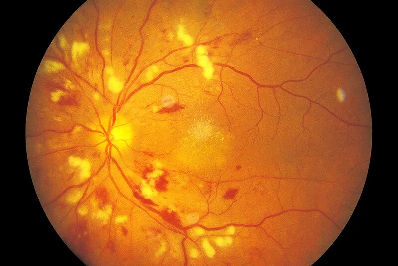 Посттромботическая ретинопатия. Ишемическая ретинопатия. Злокачественная гипертоническая ретинопатия. Диабетическая ретинопатия сетчатки глаза.