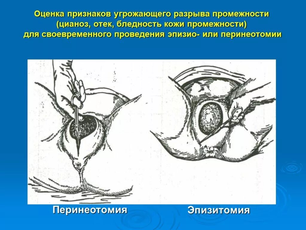 Степени разрывов при родах. Разрыв промежности в родах. Разрыв 1 степени при родах. Три степени разрыва промежности. Разрыв промежности 1 степени при родах.