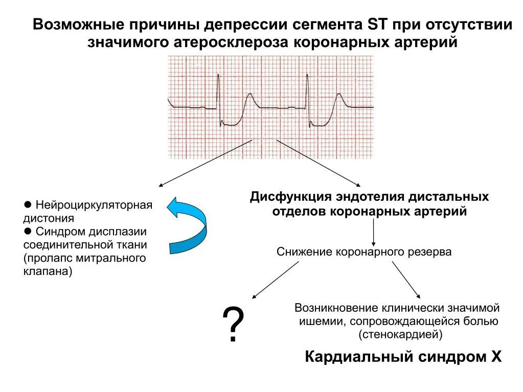 Депрессия сегмента st. Элевация и депрессия сегмента St на ЭКГ. Косонисходящая депрессия сегмента St. Диффузная депрессия сегмента St на ЭКГ. Депрессия сегмента St на ЭКГ v5 v6.