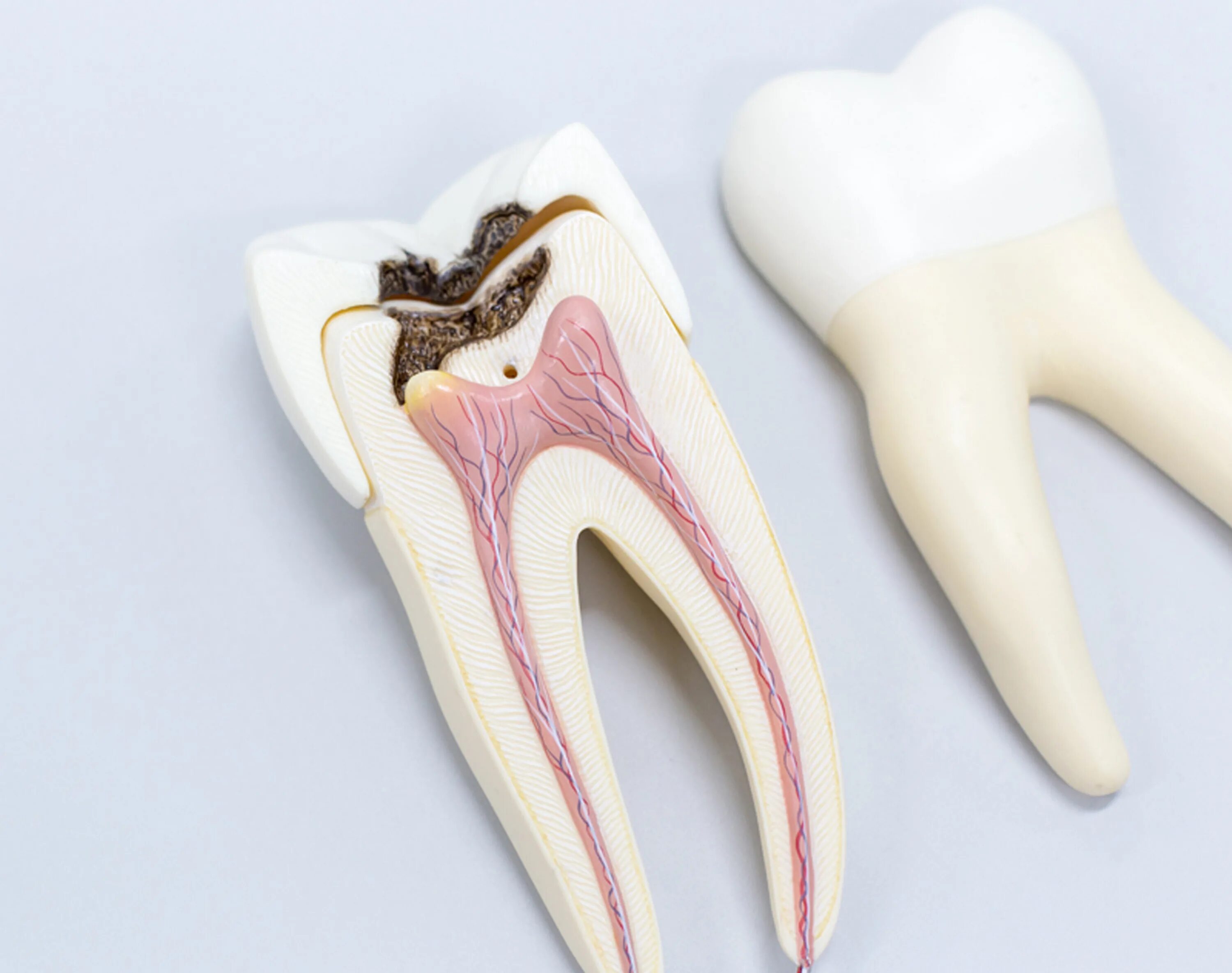 Временное лечение каналов зуба. Глубокий пришеечный кариес. Пульпит 2 канального зуба.