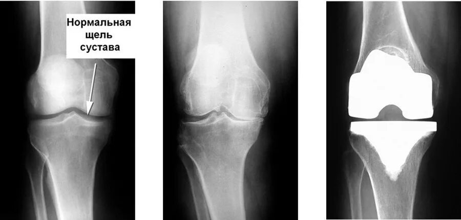 Мрт после эндопротезирования. Остеомиелит коленного сустава рентген. Остеомиелит эндопротеза коленного сустава. Рентген эндопротеза коленного сустава. Синовит коленного сустава рентген.