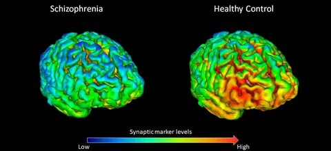 Schizophrenia slowed