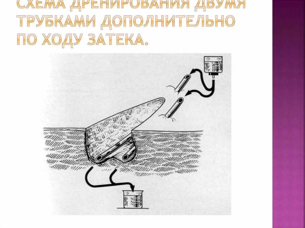 Дренаж по редону