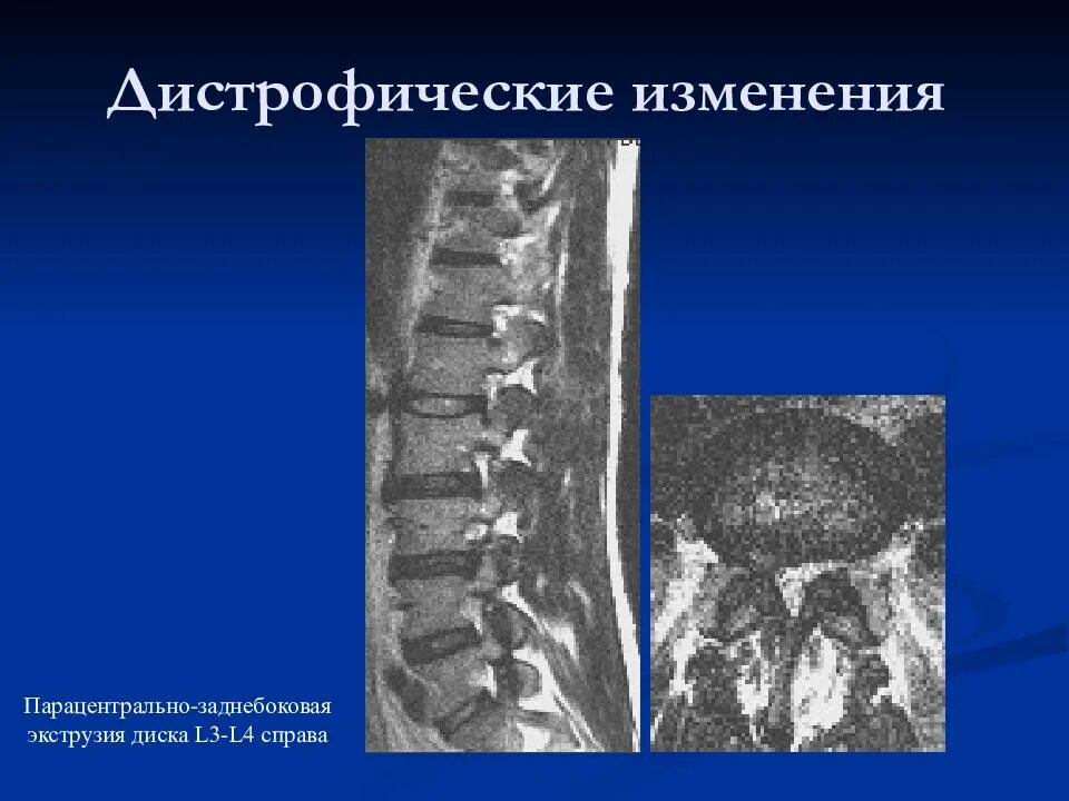 Как лечить дистрофические изменения