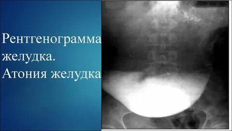Атония желудка