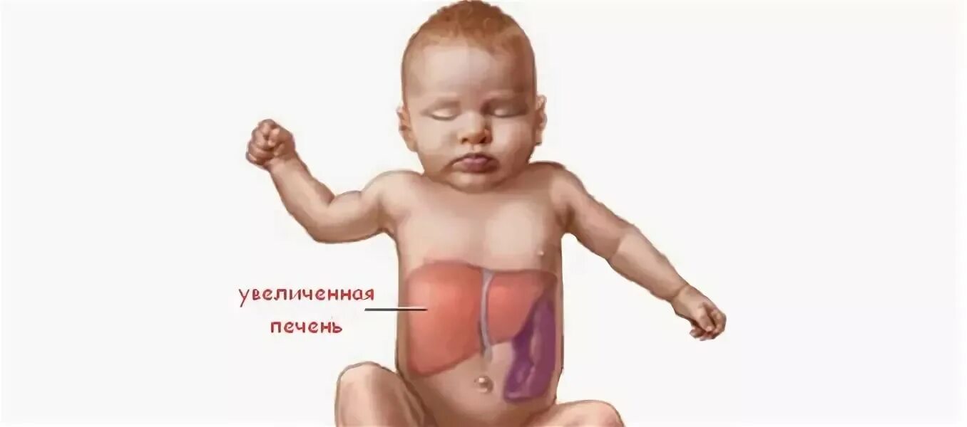 Печень увеличена на 1. Синдром гепатоспленомегалия симптомы. Гепатоспленомегалия у новорожденного. Гепатомегалия у новорожденных детей. Гепатомегалия печени у малыша.