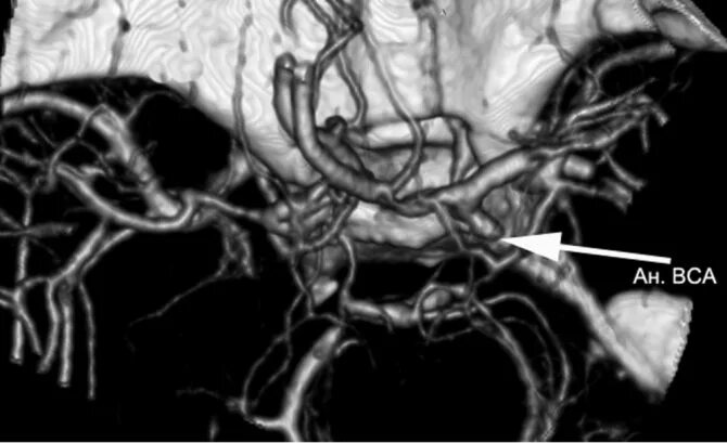 Аневризма сонной артерии что это. Мешотчатая аневризма ВСА. Аневризма сонной артерии кт. Аневризма субклиноидного отдела ВСА. Аневризма супраклиноидного отдела ВСА.
