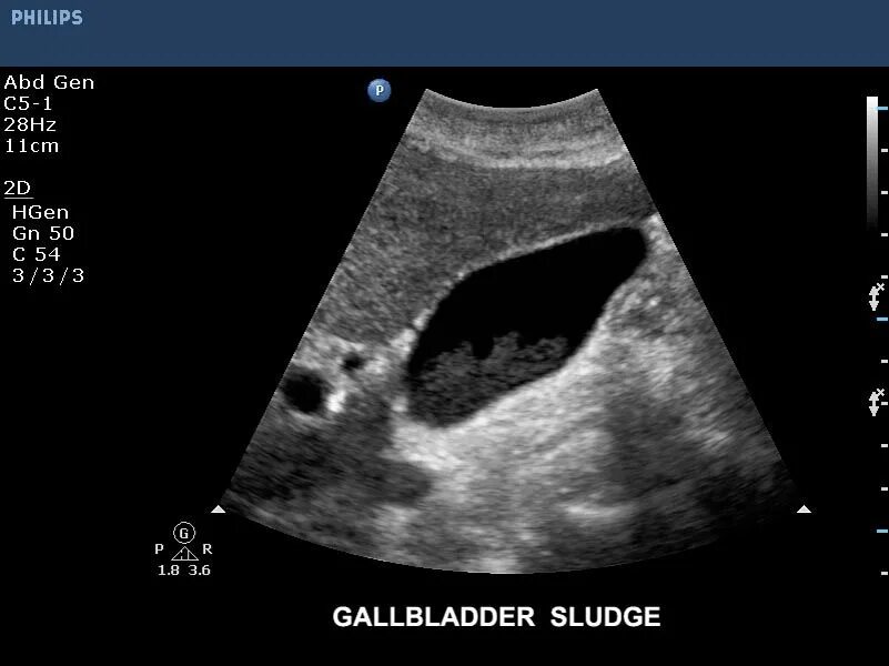 Камень в шейке желчного пузыря. Конкременты желчного пузыря УЗИ. Камни в желчном пузыре УЗИ снимок. Конкремент в шейке желчного пузыря на УЗИ. Снимок УЗИ камня в желчном.