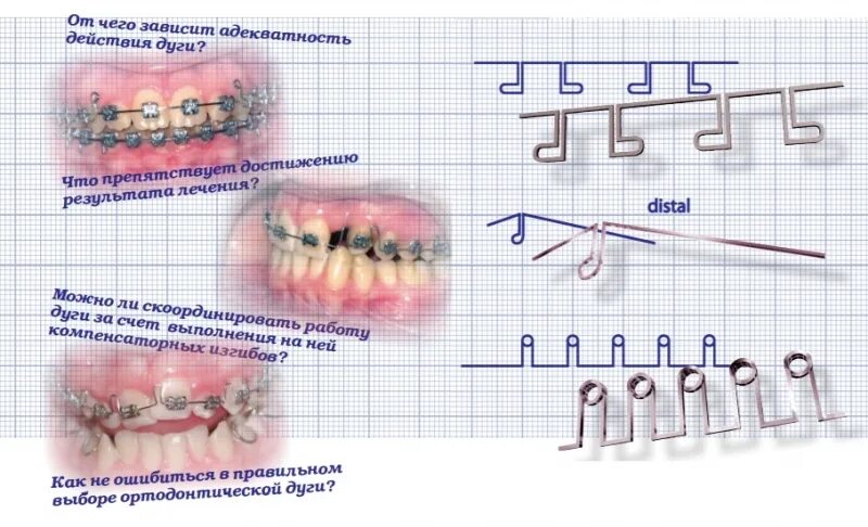 Изгиб зубов. Чертеж брекета ортодонтического. Плетеные дуги в ортодонтии.