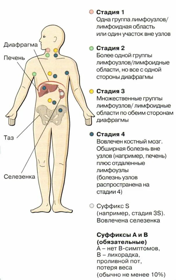 Лимфома первые признаки. Лимфома ходжкина лимфоузлы поражение. лимфома ходжкина паховые лимфоузлы. клиническая картина болезнь ходжкина. неспецифические клинические симптомы лимфомы ходжкина:.