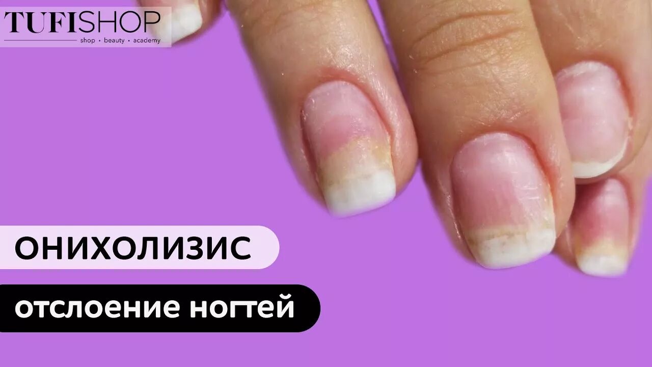 Литеральный онихолизис. Холизис