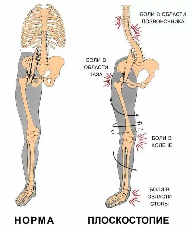 У ребенка в пояснице. Влияние плоскостопия на коленные суставы. Косолапие и плоскостопие. Стопа и позвоночник. Осложнения плоскостопия.