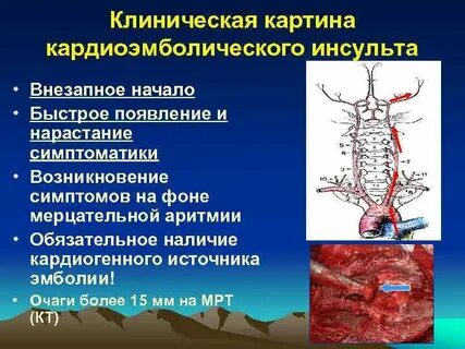 Поражение сосудов мозга это