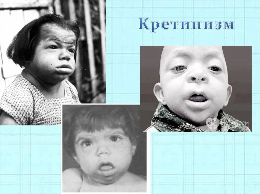 критинизм это