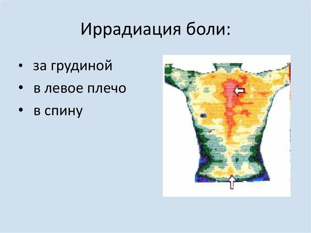 Иррадиация боли при язве. Иррадиация боли в левое плечо. Иррадиация боли желудка.