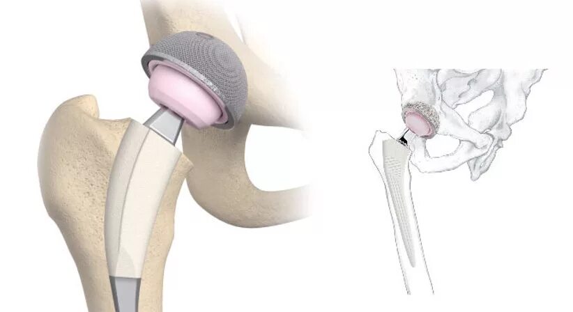 Как происходит операция по замене тазобедренного сустава. Sanatmetal эндопротез тазобедренного сустава. Операция эндопротезирование тазобедренного сустава схема. Эндопротез тазобедренного сустава операция. Цементный эндопротез тазобедренного сустава.