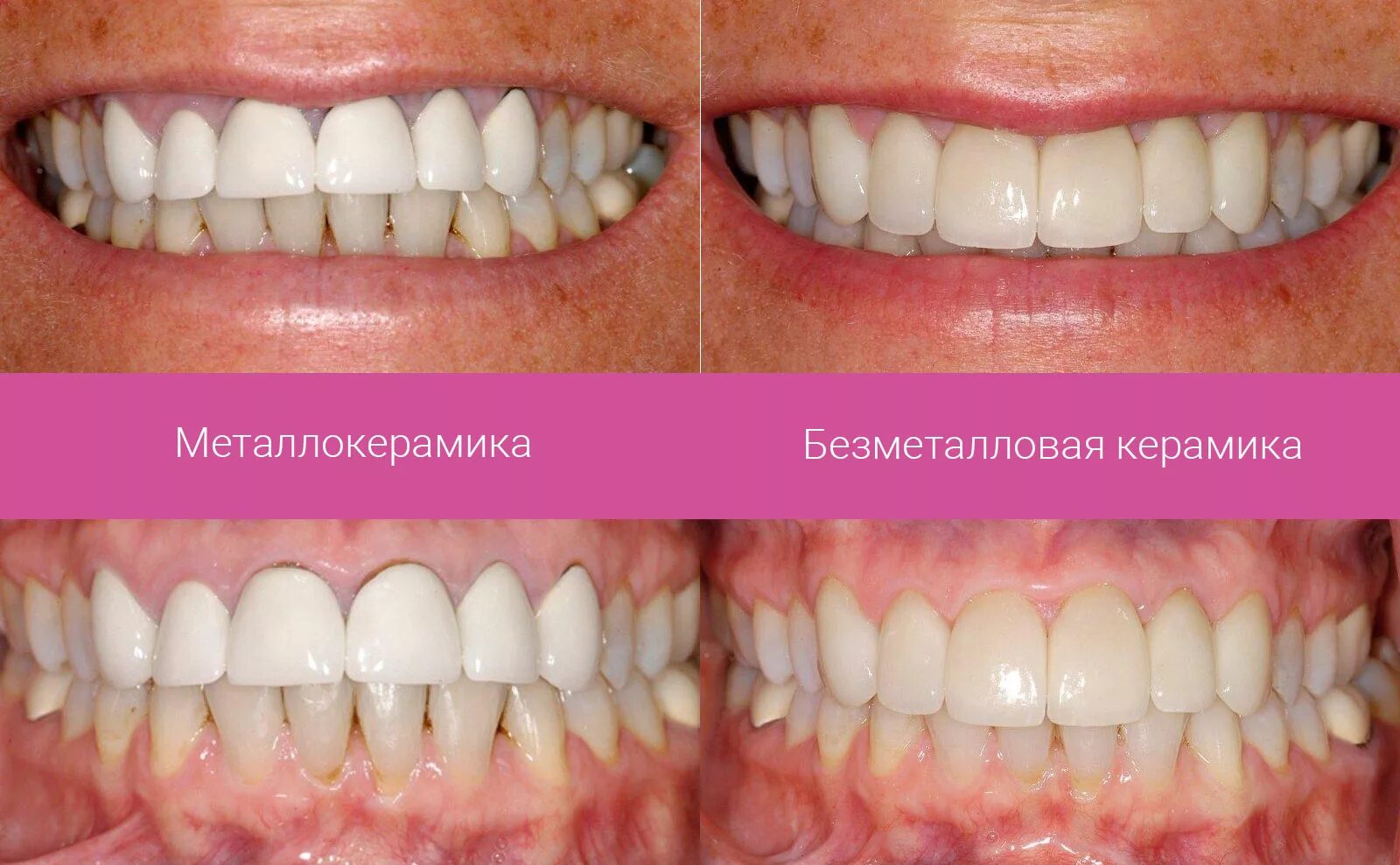 Коронка диоксид циркония и металлокерамика. Безметалловая керамика диоксид циркония. Диоксид циркония коронки. Коронки диоксид циркония а1.