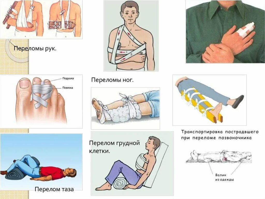 Приложить грелку при вывихе. Неотложная помощь при вывихе. неотложная помощь при вывихах на догоспитальном этапе. при вывихе на догоспитальном этапе необходимо. неотложная помощь при переломе грудной клетки.