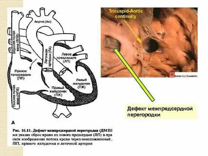 Тест дефект межпредсердной перегородки по утвержденным клиническим