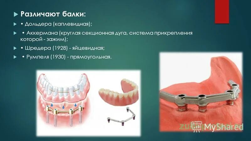 бюгельный протез а16. балочная система фиксации бюгельных протезов. балочная система шредера. балочная система фиксации бюгельных протезов.